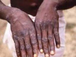 Des cas de variole du singe détectés dans le Sud-Ouest du Cameroun Mardi 11 Octobre 2022 20:30 1 Variole de singe e1665564543202