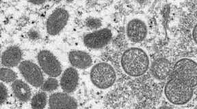 L'OMS veut appeler la variole du singe mpox 1 MonkeyPox e1669718409958