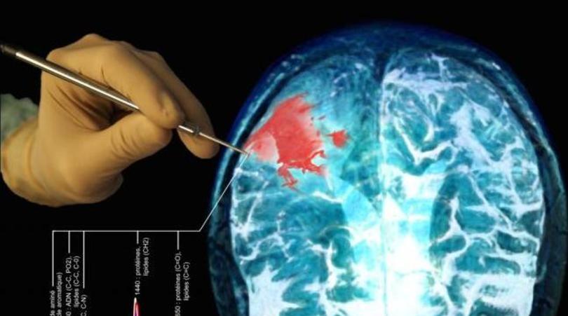 1505039327cancer tumeur cerveau sonde invention