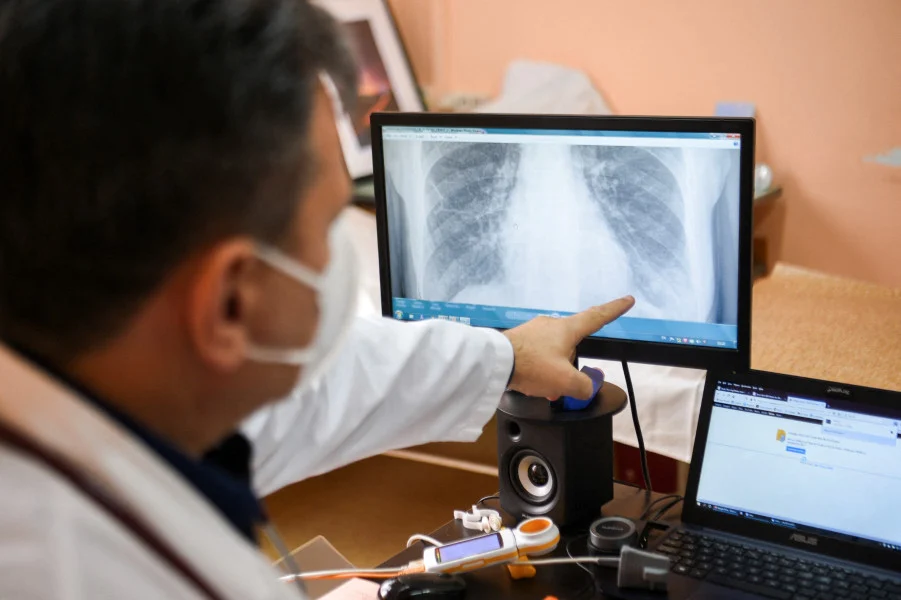 Royaume-Uni:l’IA au service du diagnostic précoce du cancer du poumon